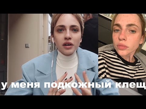 Видео: КАК Я ВЫЛЕЧИЛА КОЖУ? | подкожный клещ | модельная жесть