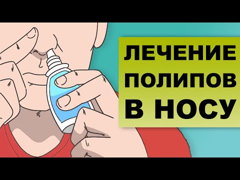 Видео: ЛЕЧЕНИЕ ПОЛИПОВ В НОСУ