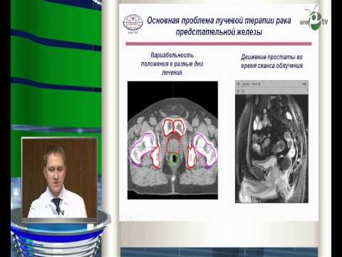 Видео: Крупнофракционная дистанционная лучевая терапия рака предстательной железы