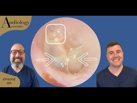 Видео: Набор для удаления ушной серы, включая ретракционный карман/ателектаз - EP815