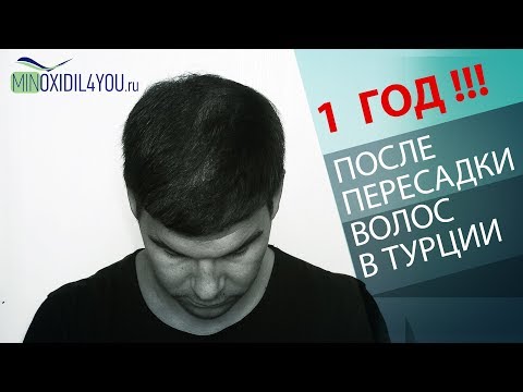 Видео: ПЕРЕСАДКА ВОЛОС В ТУРЦИИ 1 ГОД РЕЗУЛЬТАТ. Мой результат после пересадки волос в Турции Minoxidil4you