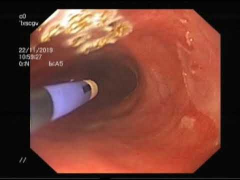Видео: АРГОНОПЛАЗМЕННАЯ КОАГУЛЯЦИЯ (АПК) ПИЩЕВОДА БАРРЕТТА (РНЦХ)