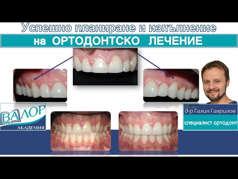 Видео: Камуфлажно лечение на трети скелетен клас с екстракция на долен резец #ортодонтия #ортодонт #брекети