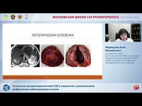 Видео: Медведева Б. М. Сложности лучевой диагностики ГЦР у пациентов с хроническими диффузными за