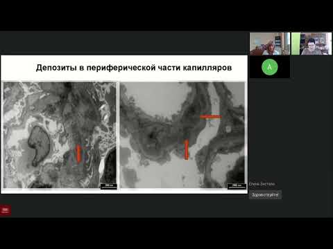 Видео: Болезнь Берже