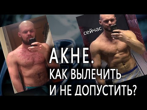 Видео: КАК ВЫЛЕЧИТЬ АКНЕ