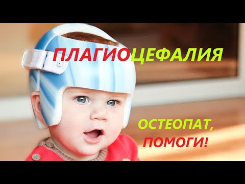 Видео: У ребенка деформирован череп. Есть кривошея. Остеопат, помоги!