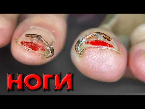 Видео: ⁉️СЮРПРИЗ на Педикюре.🤯 ПРОВОЛОКА от ВРОСШЕГО НОГТЯ. ТРЕШ от другого мастера. ноготь на ногте болит