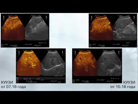 Видео: Когда УЗИ печени оказалось информативнее КТ