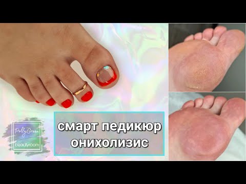 Видео: Смарт педикюр 👣 Полная обработка стоп и пальцев ног 💥 Онихолизис, что делать?