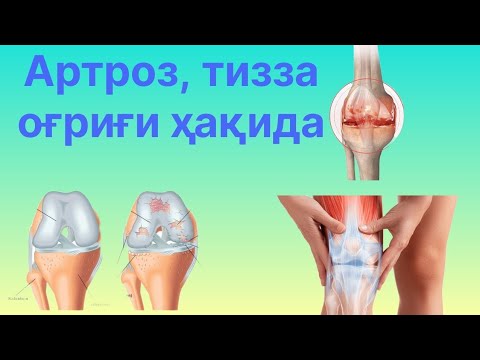 Видео: Артроз, тизза оғриғи, Гонартроз келиб чиқиши САБАБЛАРИ ва даволаш усули #kineziologiya