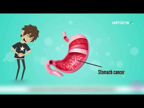 Видео: Асқазан обыры | Шипа