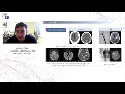 Видео: Синдром церебральной гиперперфузии. к.м.н. Демин Дмитрий Алексеевич