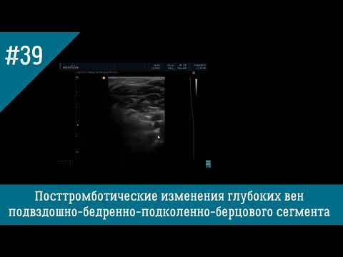 Видео: УЗИ вен. Посттромботические изменения глубоких вен нижних конечностей