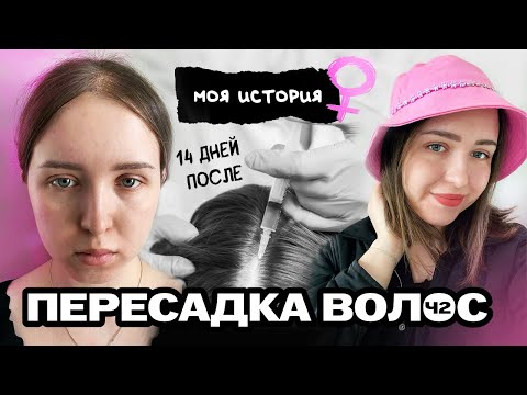 Видео: 14 дней после пересадки волос. Метод FUE. Честный отзыв.
