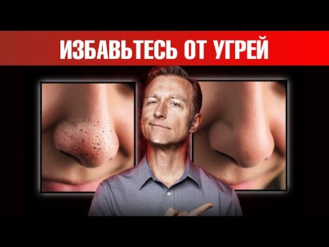 Видео: Как НАВСЕГДА избавиться от черных угрей и сальных нитей? 🧐