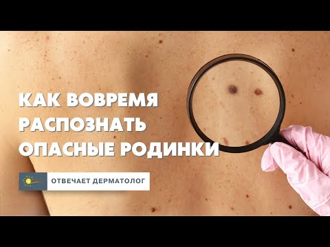 Видео: Опасные и неопасные родинки