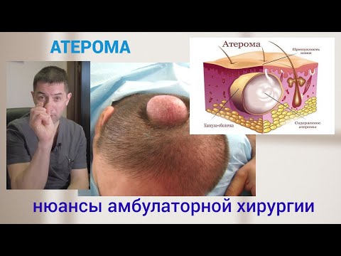 Видео: Атерома. Нюансы амбулаторной хирургии