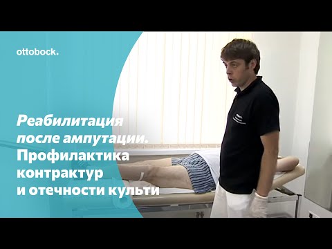 Видео: Реабилитация после ампутации. Профилактика контрактур и отечности культи