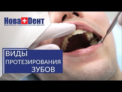 Видео: Протезирование зубов при полной потере. 🔬 Варианты протезирования при полной потере зубов. НоваДент