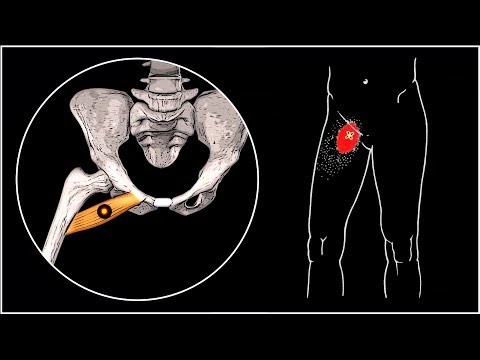 Видео: БОЛИТ ПАХ И БЕДРО 🔴 Гребенчатая мышца и миофасциальный болевой синдром