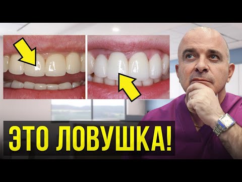 Видео: МЕТАЛЛОКЕРАМИКА или ЦИРКОНИЙ! Какие коронки выбрать в 2023 году?