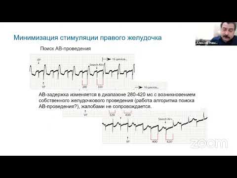 Видео: ЭКГ феномены работы алгоритмов современных кардиостимуляторов при холтеровском мониторировании