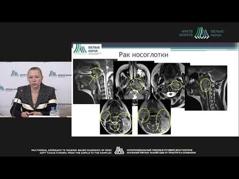 Видео: МР-томография в дифференциальной диаг-ке опухолевых и восп.пораж. миндалин лимфоидного глоточ.кольца