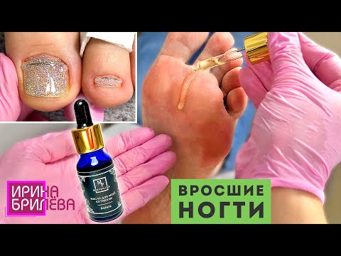 Видео: ВРОСШИЙ НОГОТЬ 🌸 Установка Титановой нити (NiTi) 🌸 ПЕДИКЮР 🌸 Ирина Брилёва