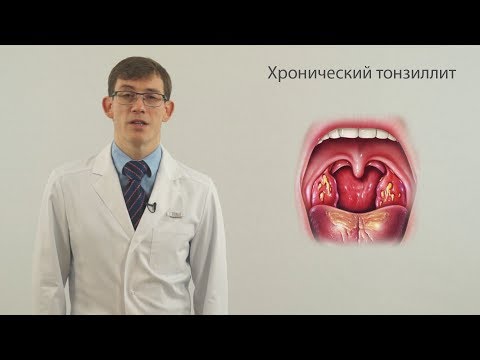 Видео: Хронический тонзиллит ч1 (боль в горле, запах изо рта)