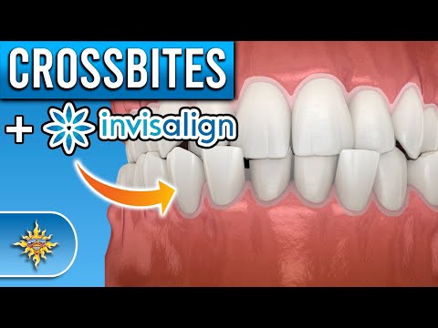 Видео: Может ли Invisalign исправить перекрестный прикус?