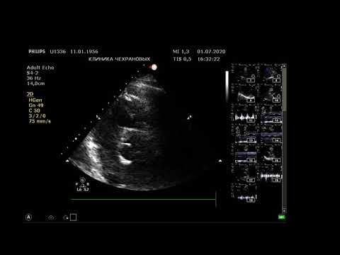 Видео: УЗИ сердца , 64 года. Эхокардиография. Philips CX 50