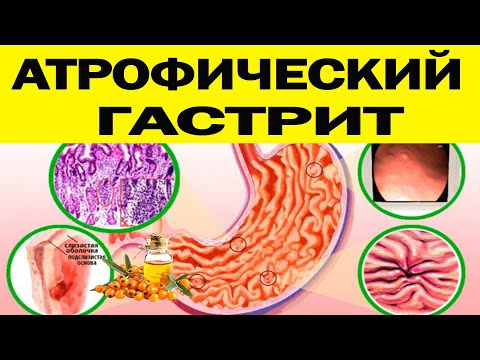 Видео: ЛЕЧЕНИЕ АТРОФИЧЕСКОГО ГАСТРИТА! А так же Диета, Диагностика, Контроль, Причины, Осложнения, Симптомы