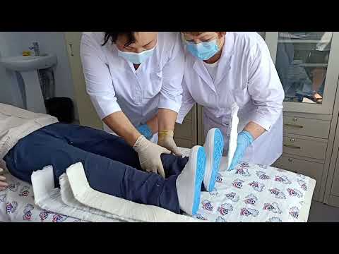 Видео: Сан сүйегінің жабық сынуында Крамер жақтауын орнату