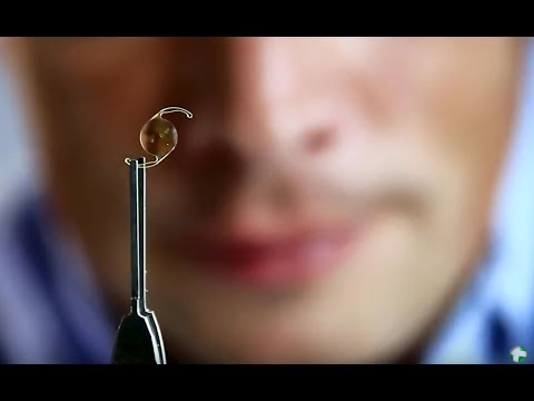 Видео: Вторичная катаракта после замены хрусталика. Центр Ока