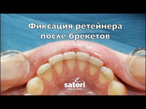 Видео: Как правильно фиксировать ретейнер | брекеты | стоматология Самара