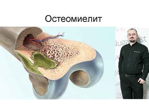 Видео: Остеомиелит