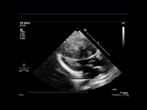 Видео: Протокол ЭхоКГ у детей парастернальная проекция, длинная ось левого желудочка Часть I (рус. перевод)