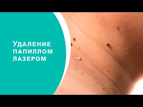 Видео: Удаление папиллом лазером