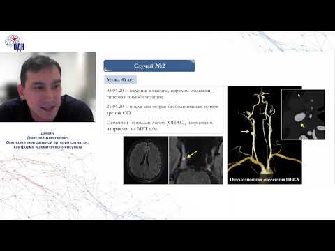 Видео: Окклюзия центральной артерии сетчатки, как форма ишемического инсульта. к.м.н. Демин Д.А.