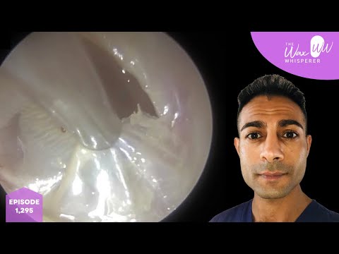 Видео: 1,295 - Пилинг омертвевшей кожи ушей