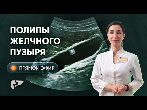 Видео: Что нужно знать о полипах желчного пузыря?