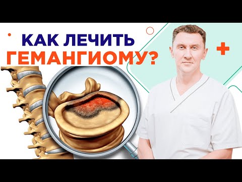 Видео: Как лечить гемангиому позвоночника правильно!Нейрохирург