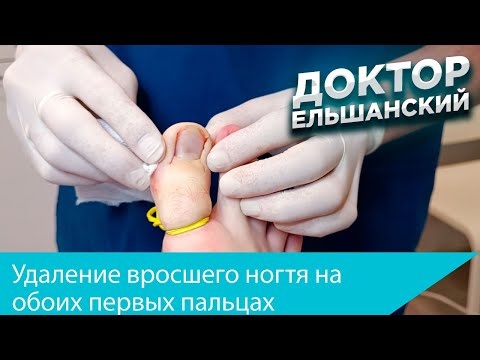 Видео: Хирургическое лечение вросшего ногтя на обоих первых пальцах с 2 х сторон