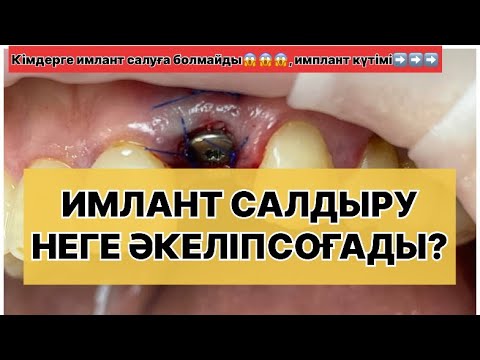 Видео: ЖАСАНДЫ ТІС  | ИМПЛАНТ тіс ПАЙДАСЫ мен ЗИЯНЫ | Кімдерге имлантант салдыруға болмайды ТОЛЫҚ АҚПАРАТ