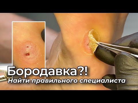 Видео: Не могли точно определить что это #бородавка #мозоль