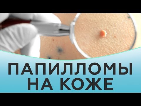 Видео: Папилломы на коже. Что нужно знать о папилломах?