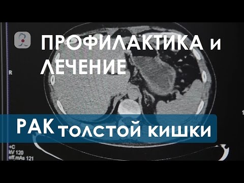 Видео: Рак толстой кишки. Перспективы лечения рака толстой кишки. Клиника колопроктологии.