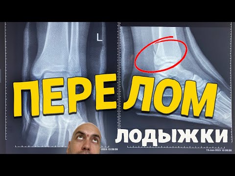 Видео: Перелом лодыжки. Гипс, расходы, лечение. Мой опыт.