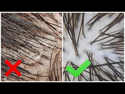 Видео: ДЕТОКС КОЖИ ГОЛОВЫ 🍀 КАК ИЗБАВИТЬСЯ ОТ ПЕРХОТИ И ЖИРНОЙ КОЖИ ГОЛОВЫ ?